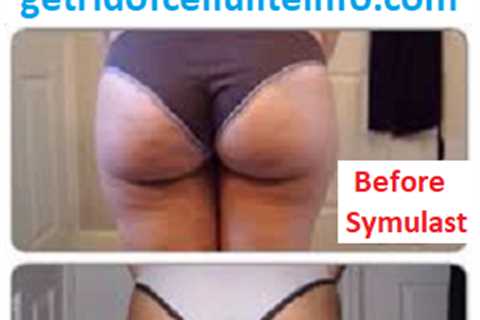 Symulast Method Review: Cellulite Before And After Pictures