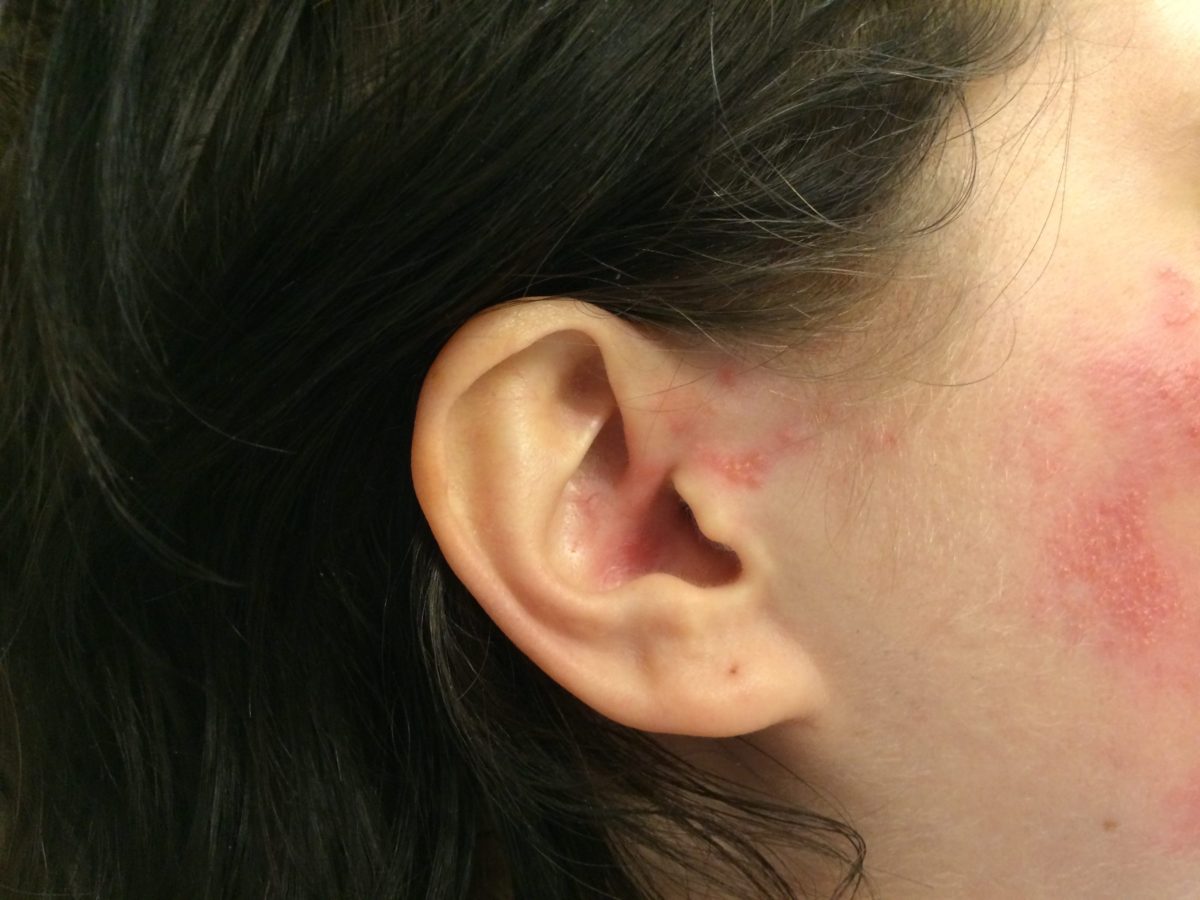 Ramsay Hunt syndrome: What is it?