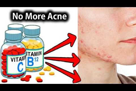 Best Minerals and Vitamins for Acne Treatment