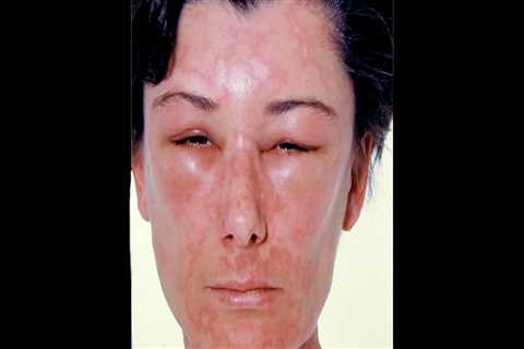 Can food cause allergy like symptoms?